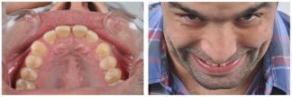protocol was simplified and reduced to 6 photos because of the utilization of the video (Fig 7). The video became a very important tool for smile design.