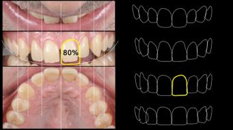 Fig 27. Interdental Width Proportion ruler calibrated over the 3 photos based on the video analysis. Step 4.