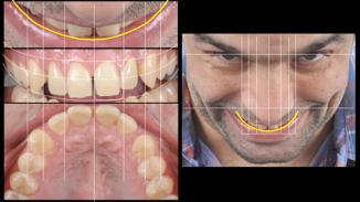 After adjusting the image to the guidelines we can zoom in and analyse the relationship between the teeth, arch curve and the vermilion curve that will help determining the ideal buccal-palatal
