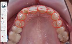 overlapped to evaluate, before removing the braces if ortho is