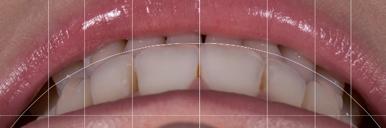 more. Thats why the DSD ortho quality control should always be done before removing the braces if conventional ortho is the case.