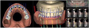 Overlapping the DSD drawings with CBCT software to analyze the
