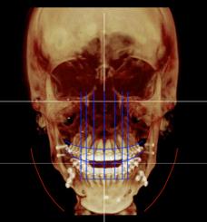 Fig 18. Overlapping the DSD guide lines with a Orthognatic software to plan the surgery according to the Smile Design analysis.