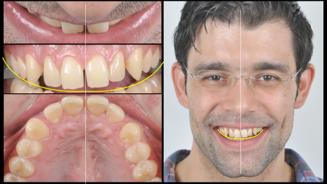 -to analyze the relationship between upper lip and incisal anterior upper edge. The literature gives us certain parameters the video analysis will guide our final guess.
