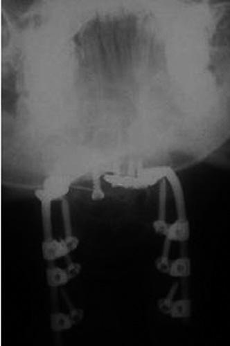 In all cases, the posterior fusion was completed at the levels which were instrumented through putting morcellized local autograft bone along with allobone over the decorticated lateral masses.