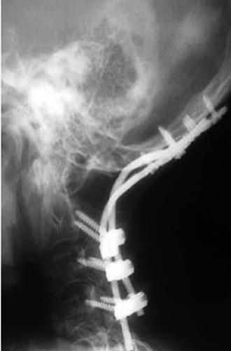 For subjects with Occipital to C 2 lesions requiring wide laminectomy, posterior fusion was not performed as this procedure was not associated with instability.