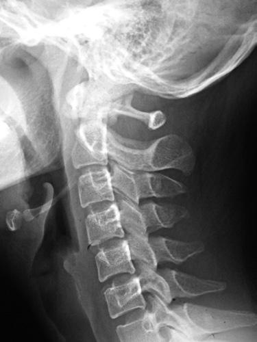 diagnosis without marked anomalies; D F: During follow-up, postoperative cervical lateral