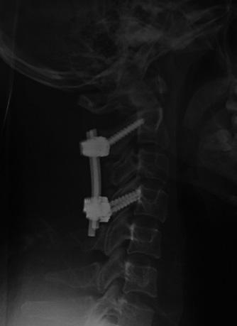 tumor at C 2/3 level; B: Axial imaging reveals the tumor located at the left side of spinal canal and extended along the foramina; C: Postoperative cervical lateral film reveals no kyphotic deformity