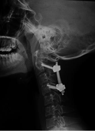 tumor at her endpoint of the follow-up 3 Discussion A multitude of pathological processes involve upper cervical spinal cord or craniocervical junction including tumors, aneurysms, congenital bony or