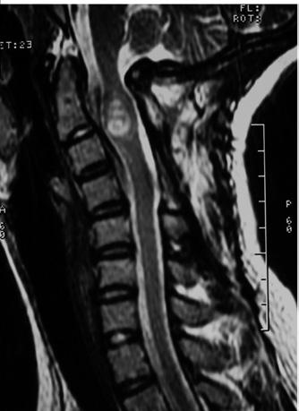 Clinical presentation of tumors in this region is variable and may be similar to that of multiple sclerosis or cervical spondylosis.