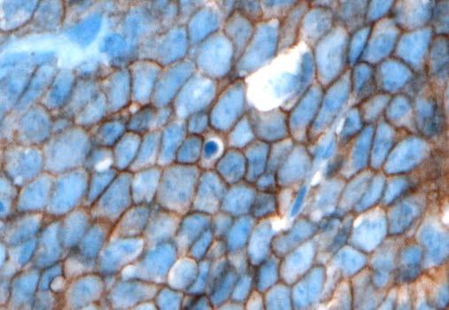 Background Documentation Figure 2. CD99 staining in Ewing sarcoma shows strong, diffuse, membranous staining. (CD99 antibody O13 with hematoxylin counterstain.