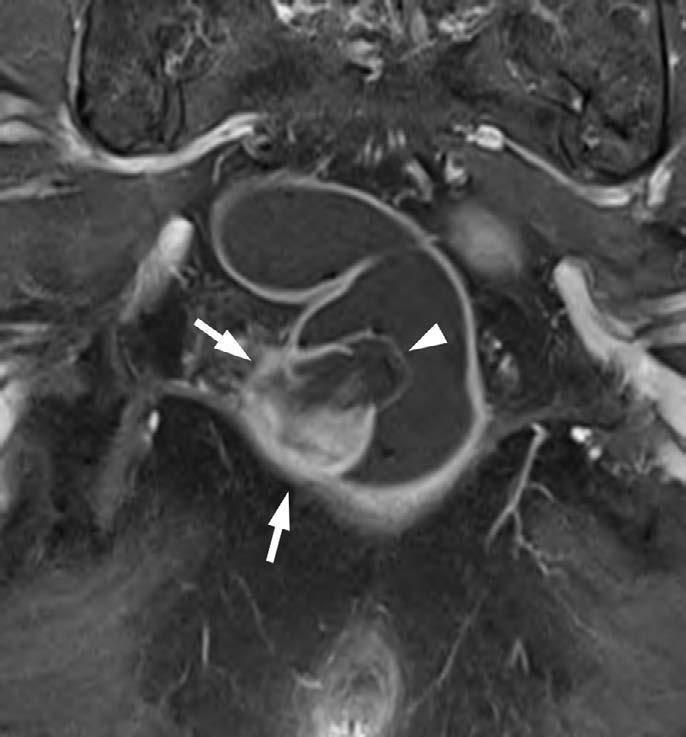 In the current study, we report an EOE case that presented as a rectal submucosal tumor, and describe the imaging and