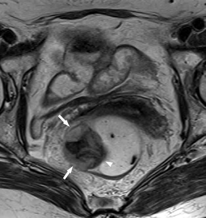 CASE REPORT A 72-year-old woman was referred to our institution for further treatment of a rectal submucosal tumor after