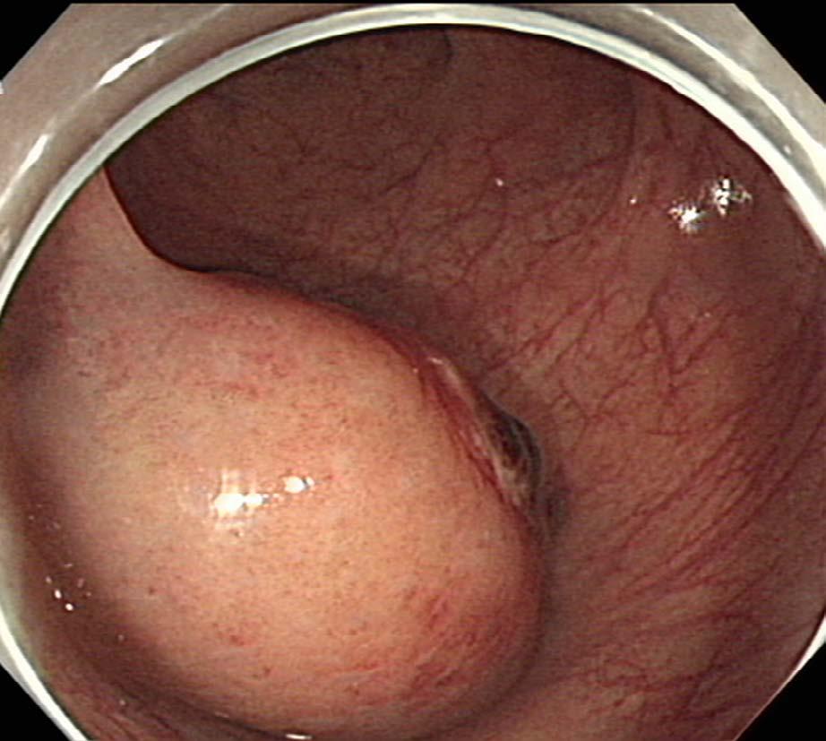 2) at the outside clinic demonstrated a subepithelial tumor measuring approximately 4 cm in the lower rectum.