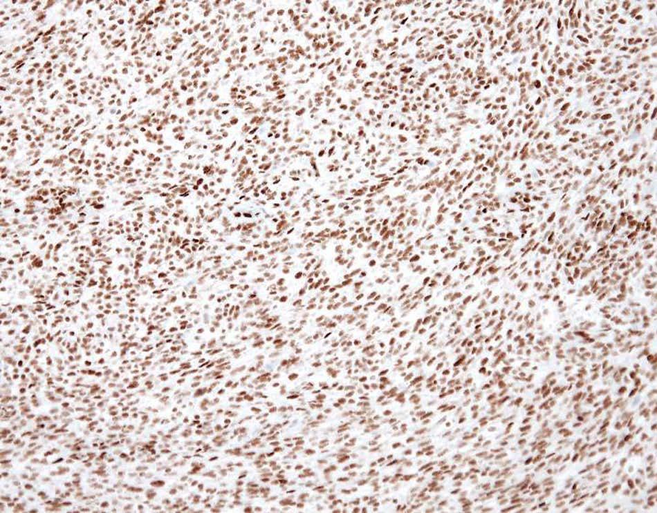 Immunohistochemistry demonstrated cytoplasmic membrane-positive CD99 and nucleus-positive Fli-1 staining of the tumor cells (Fig. 3b, c).