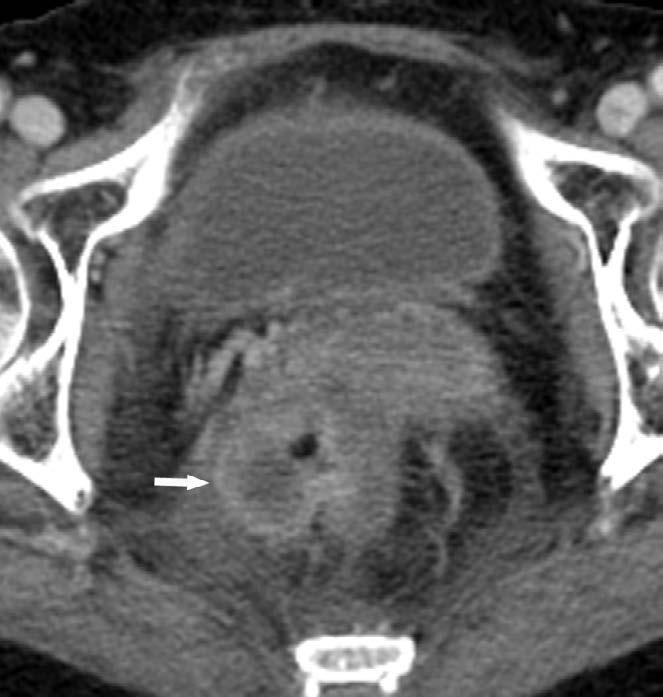 Ewing s Sarcoma of the Rectum Heejin Bae, et al. a b c Fig. 4. Preoperative imaging studies of the locally recurrent mass.