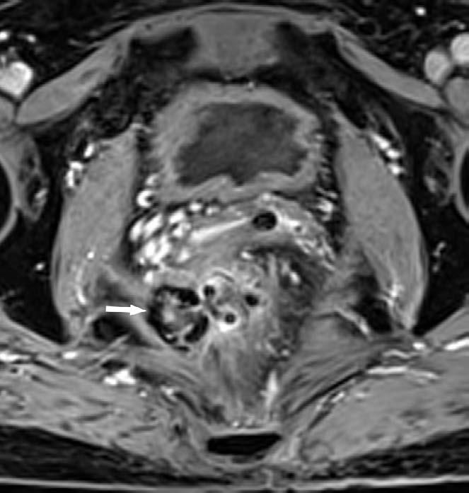 5 Gy) was performed to reduce the size of the mass. The rectal magnetic resonance imaging (MRI) obtained 2 months after the completion of radiotherapy showed that the mass had decreased to a 1.