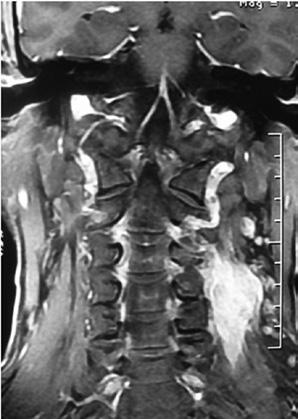 722 ZHU et al: PRIMARY DUMBBELL-SHAPED EWING'S SARCOMA OF THE CERVICAL VERTEBRA IN ADULTS Table I. Summary of the 4 cases.