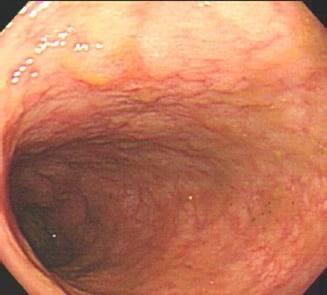 GUT INFLAMMATION: Inflammatory bowel
