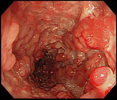 Crohn s (CD), Ulcerative colitis (UC)