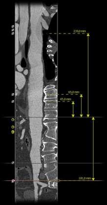 Study design Software analysis: 3Mensio Reference point: top of CT ostium; Distance to LSA Distance to proximal and distal aneurysm neck; Distance to aortic bifurcation and bilateral iliac
