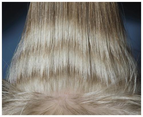 Hair Changes Presentation Hair Thinning Hair may become more brittle.