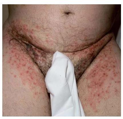 Acneform Rash Develops about 8 to 10 days after the start of treatment The occurrence of rash may