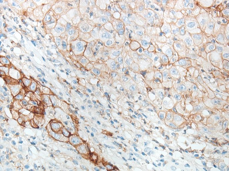 Tissue-based biomarkers for immune checkpoint inhibition Tumor cells PD-L1 expression Microsatellite instability Tumor mutational load (TML) Neoantigen burden Resistance mutations Gibney GT et al.