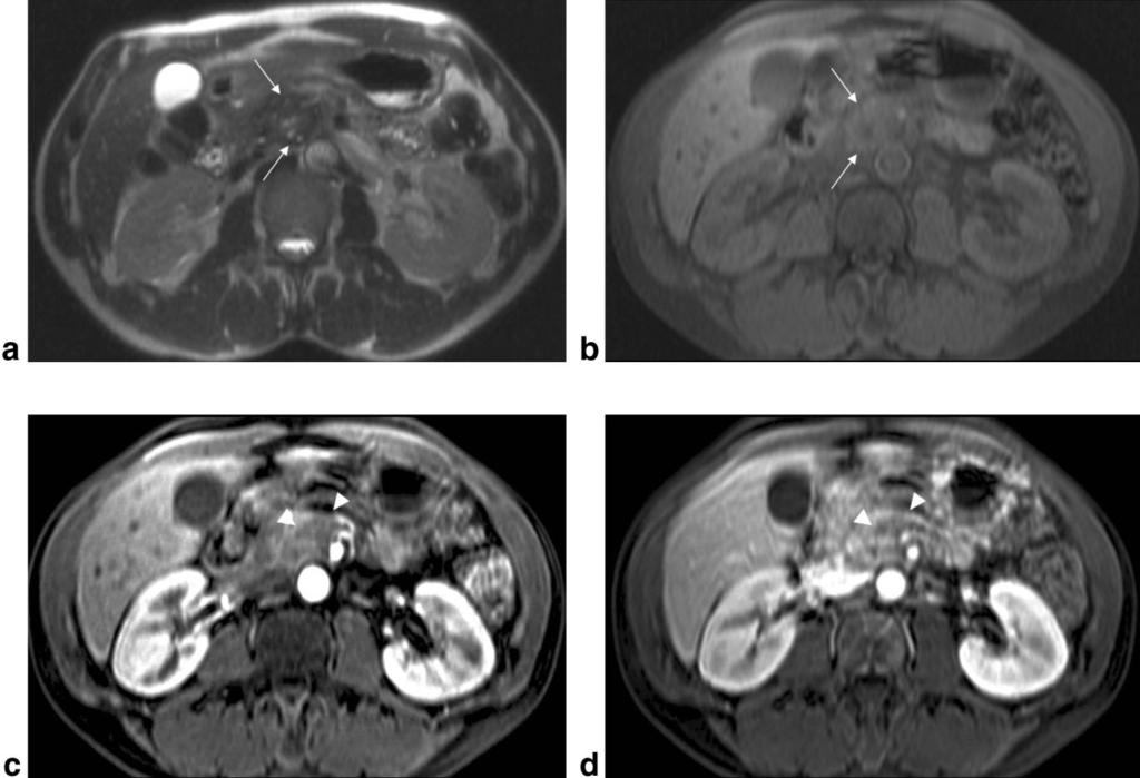 Pancreatic Mass Distinction Using 3D-GE 317 ments for two patients in the pancreatic carcinoma group.