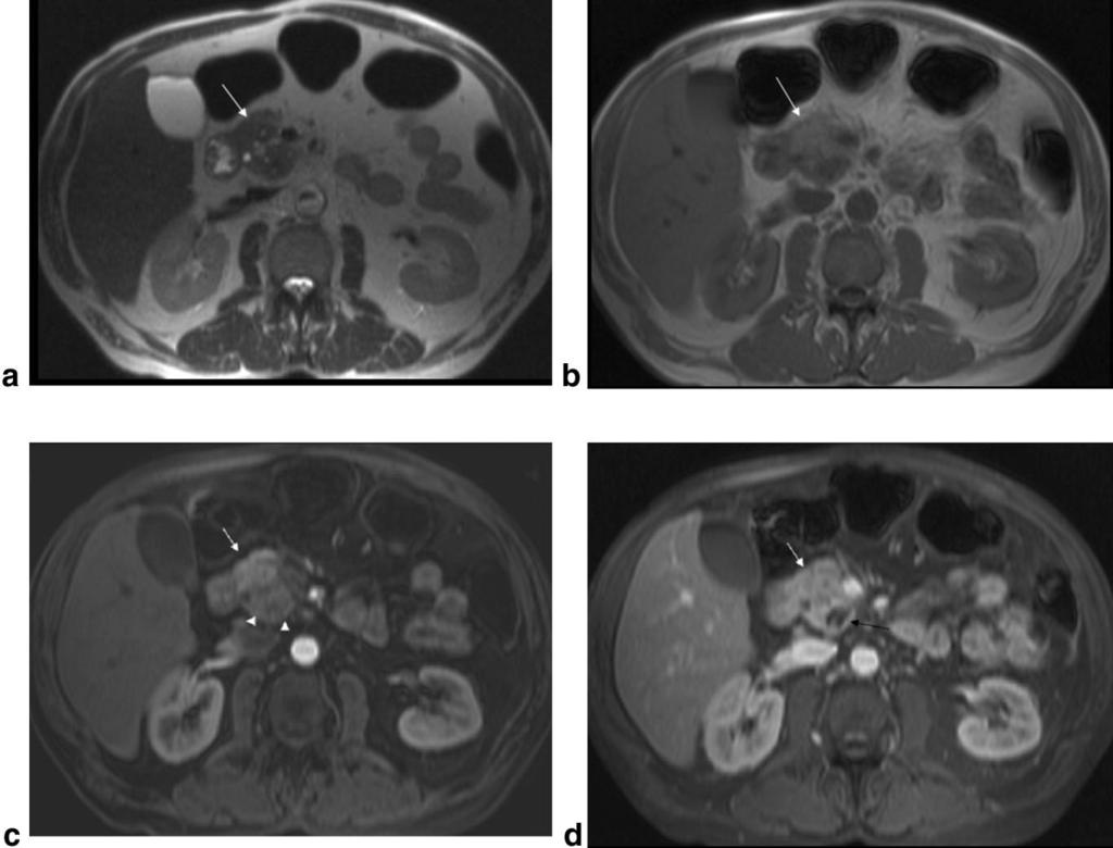 Pancreatic Mass Distinction Using 3D-GE 321 Figure 5. A 53-year-old man with focal inflammatory mass originating from chronic pancreatitis in the pancreatic head.