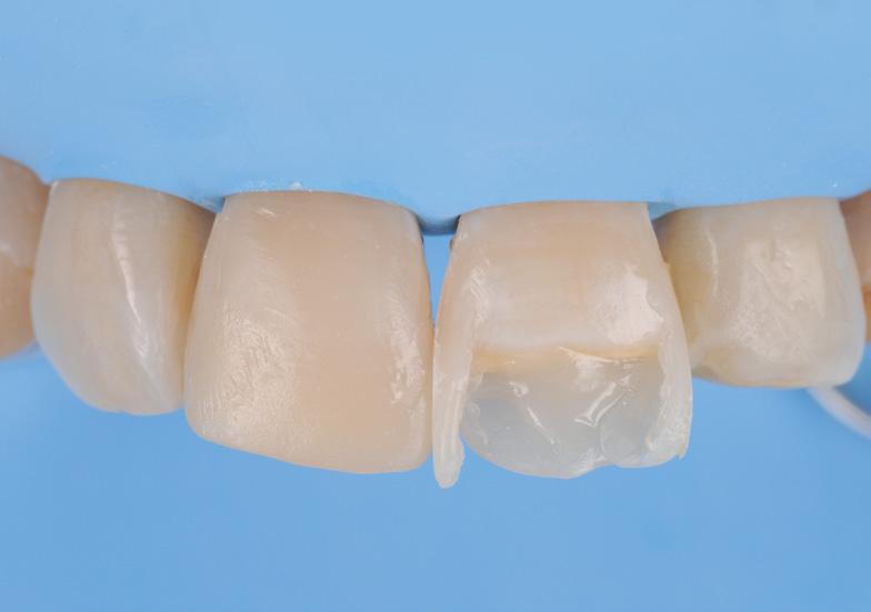Restorative was placed in 2 mm increments and light-cured
