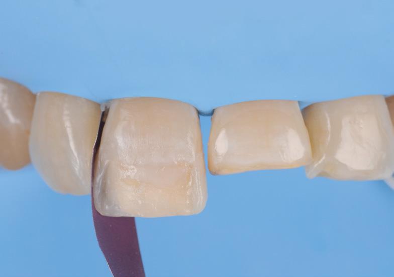 Complete removal of composite restorations and final