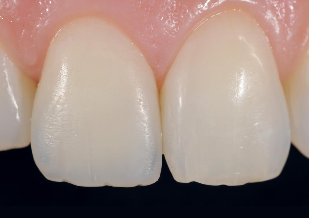 Dual Shade in Class IV Composite replacement ESTHETICS Case by Dr. Jordi Manauta Eight years ago a young patient suffered a trauma that caused the fracture of the upper right central incisor.