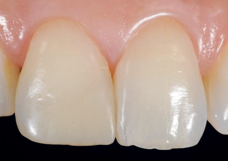 Dual Shade in Class IV Composite replacement ESTHETICS Case by