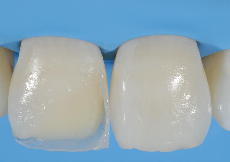 5 them mm space to for adapt the final enamel to layer all of tooth composite. surfaces.