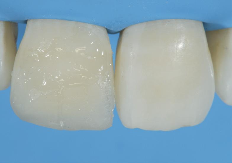 10. Placement of a dentin shade A2 of Filtek Supreme XTE Universal Restorative. 12.
