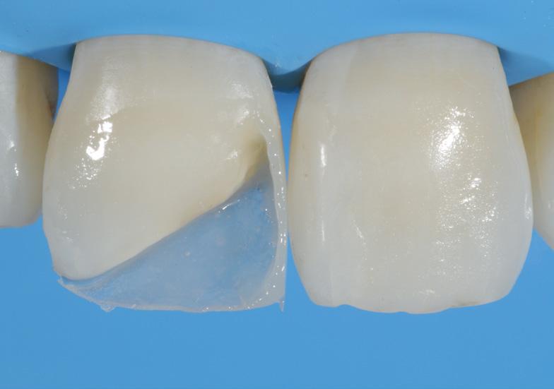 Dual Shade in Class IV Composite replacement ESTHETICS Case by Dr.