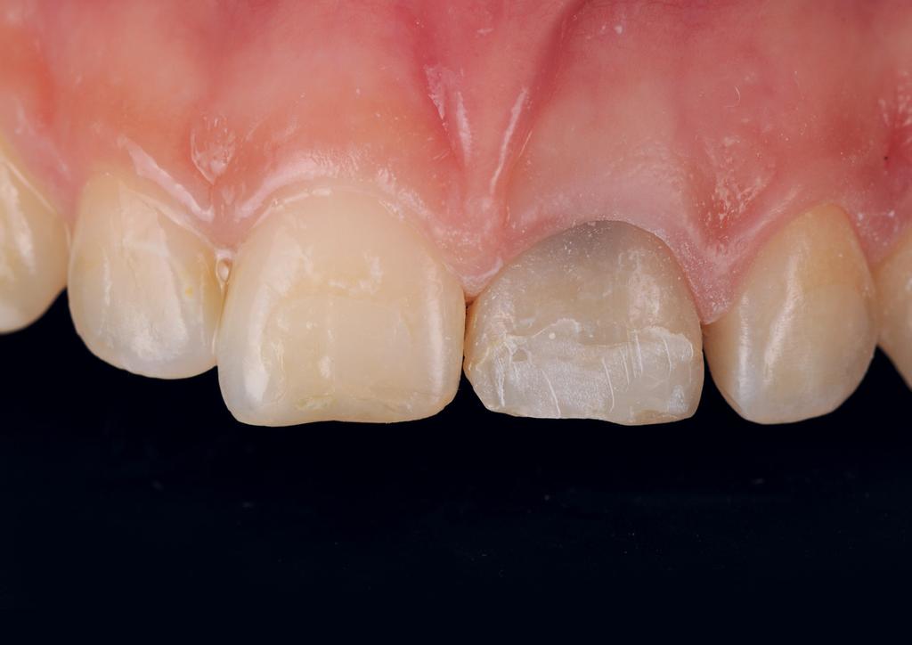 Composite Veneers Direct and lab fabricated ESTHETICS Case by Dr.