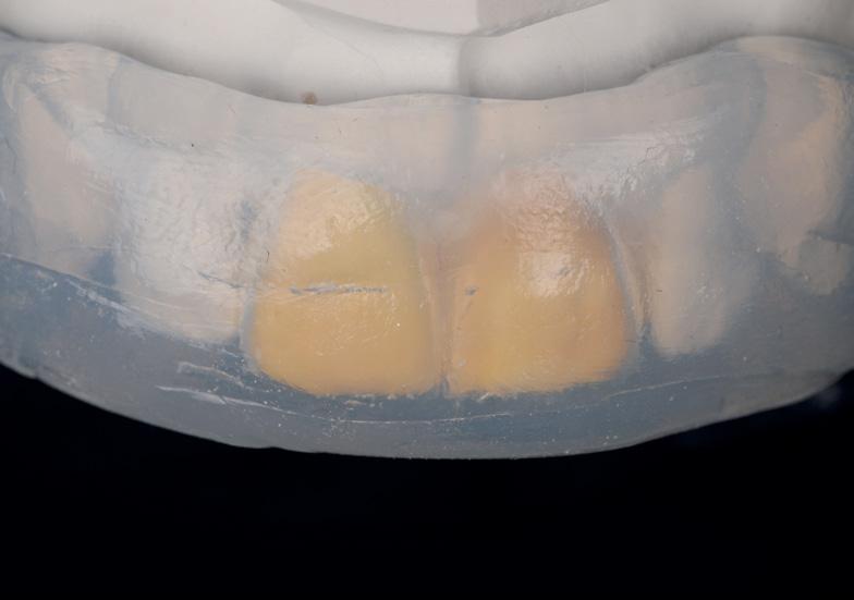 Preop: Upper right incisor is discolored and is in need of an esthetic composite restoration. Upper left incisor is necrotic and discolored.