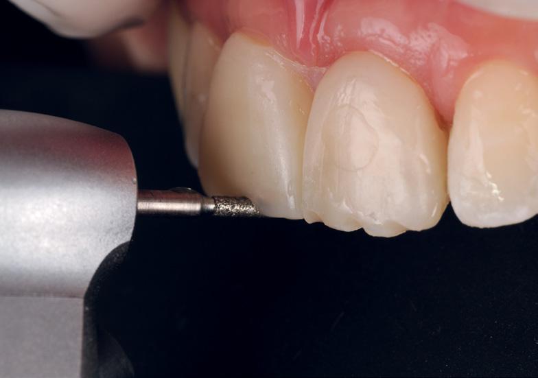 versatility and strength of Filtek Supreme XTE Universal Restorative allow for use in both
