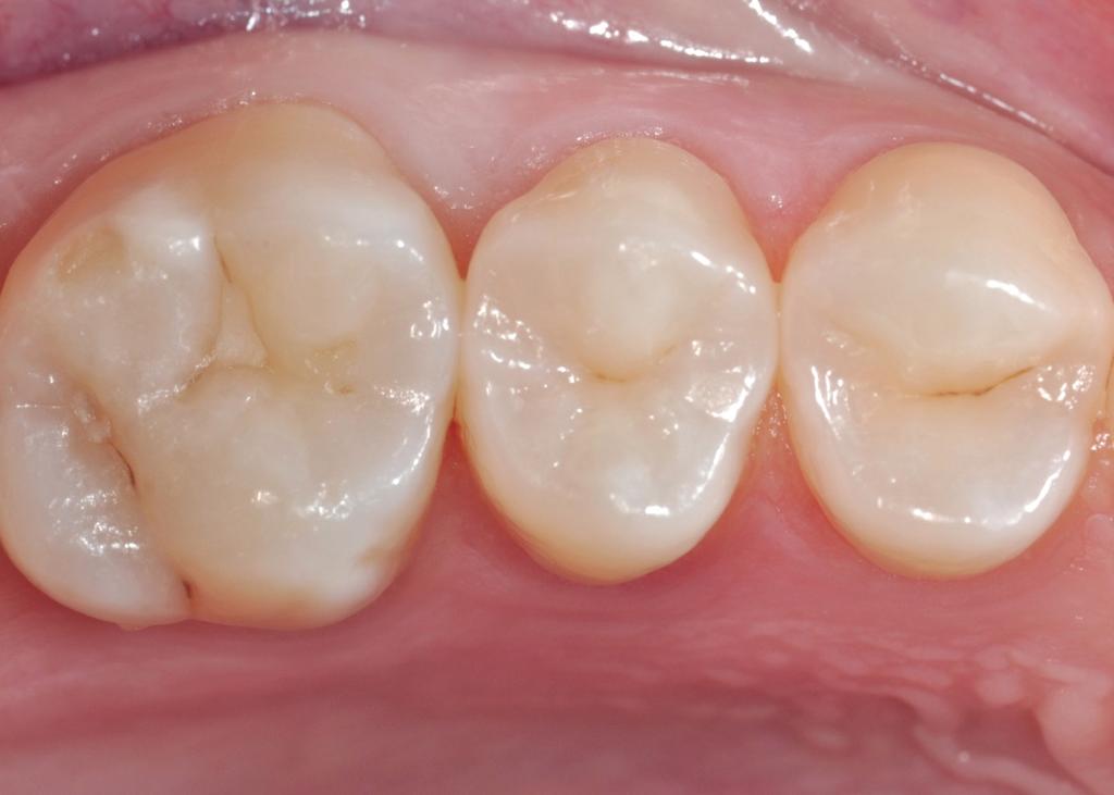 Bulk Fill in Class II Proximal caries ESTHETICS Case by Dr. Jordi Manauta A young patient was examined during a routine check-up.