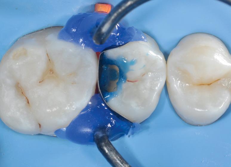with high polish retention 2. Preop: intact occlusal surface of the second 3.