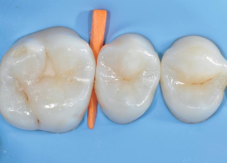 pulp. 5. Caries removal and cavity preparation.