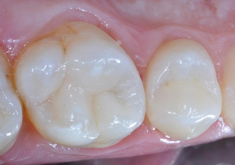 Filtek One Bulk Fill Restorative, in shade A2, is directly placed into the cavity in a single increment