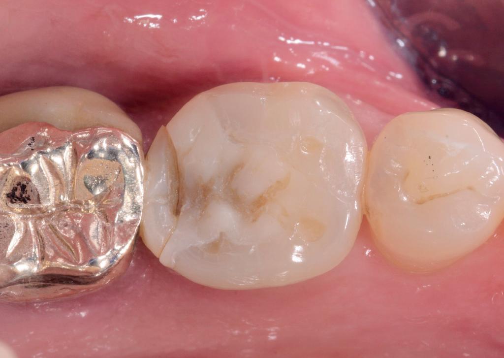 Bulk Fill in Class II Fractured composite ESTHETICS Case by Dr. Giuseppe Chiodera An adult patient presented with a Fractured composite restoration.