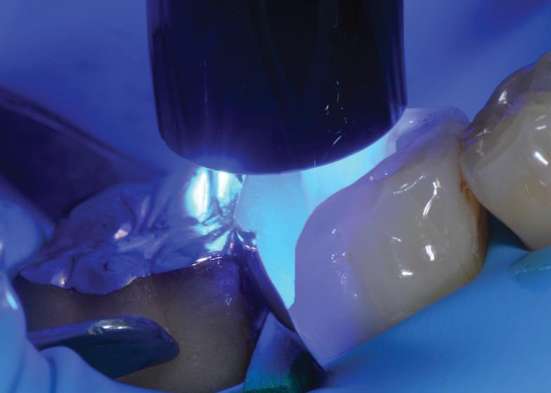 Filtek One Bulk Fill Restorative enabled a fast and easy posterior