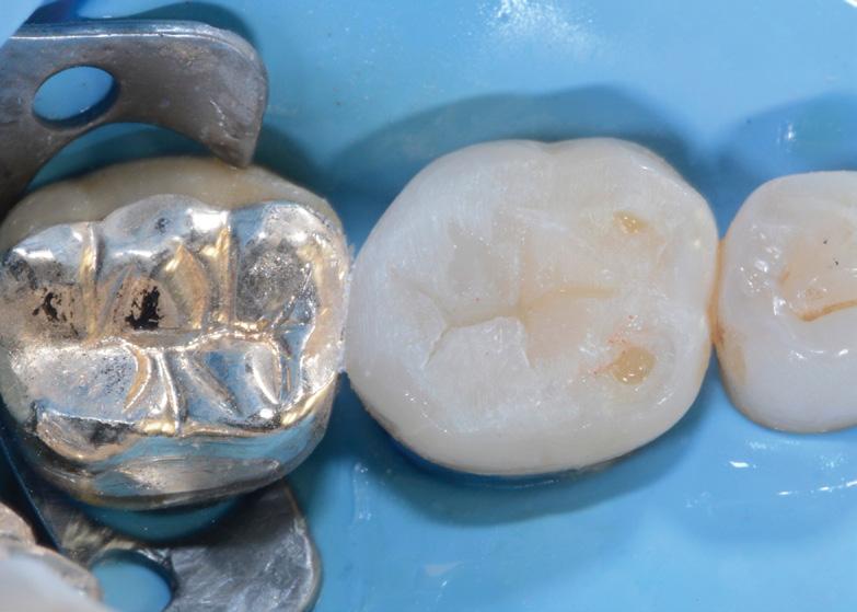 Initial situation: fractured composite restoration of first lower molar.