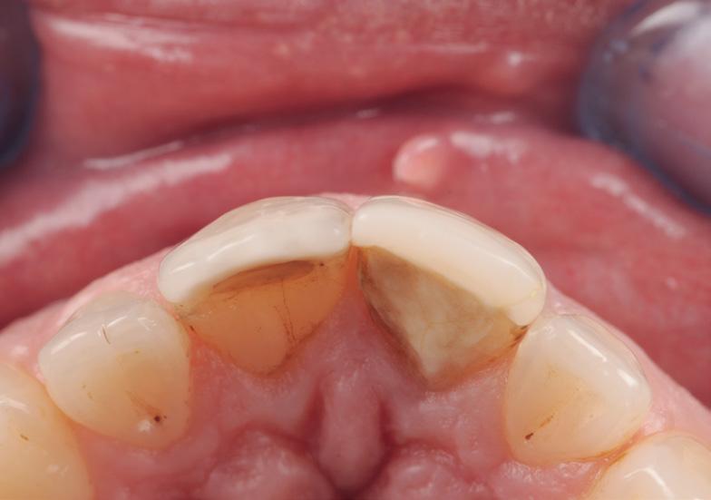 central incisor, previously treated endodontically and reconstructed with a fiber post. 3.