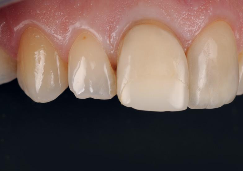 Home Anterior Ceramic Veneers ESTHETICS Misaligned teeth and discolored restorations Case by Dr.