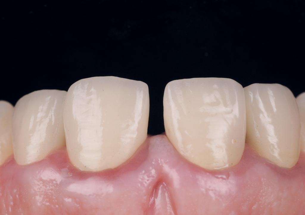 Zirconia Crowns Anterior all-ceramic crowns ESTHETICS Case by Dr. Walter Devoto, Lab Technician: Daniele Rondonni A 40 year old female patient was unsatisfied with current crowns and central diastema.